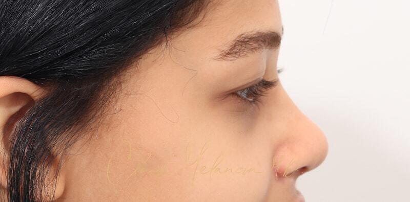 Rhinoplasty Before & After Photo