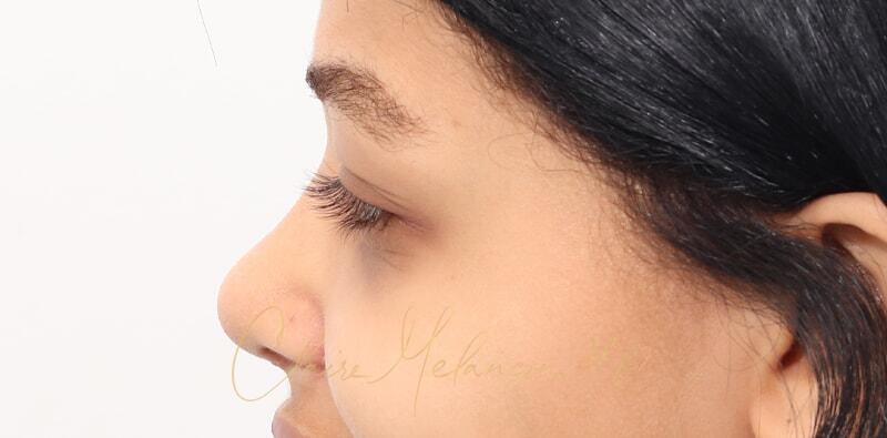 Rhinoplasty Before & After Photo