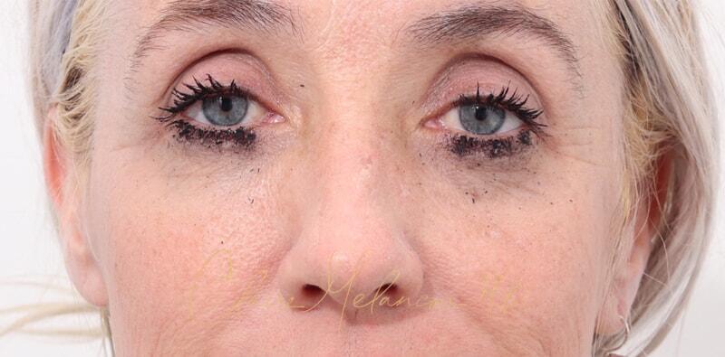 Rhinoplasty Before & After Photo