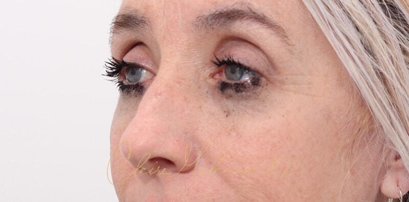 Rhinoplasty Before & After Photo