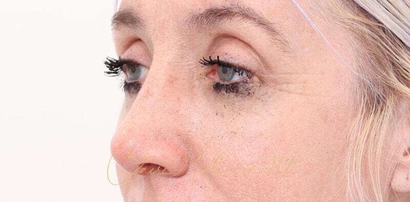 Rhinoplasty Before & After Photo
