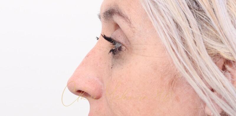 Rhinoplasty Before & After Photo