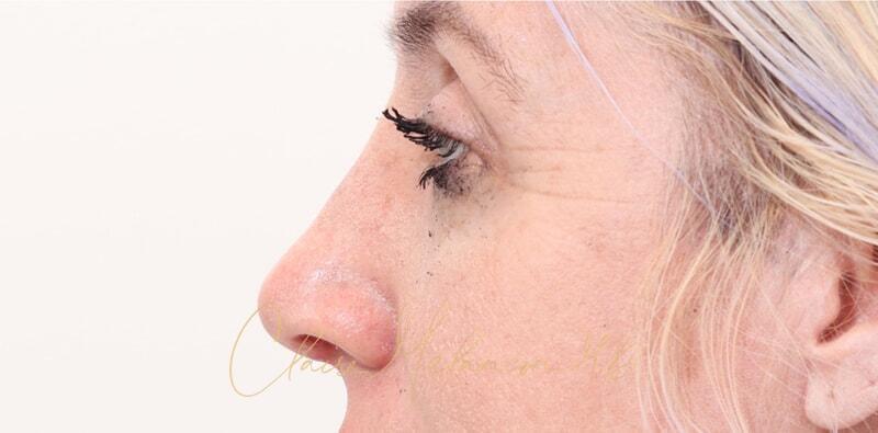 Rhinoplasty Before & After Photo