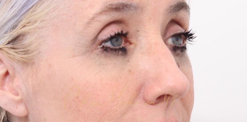 Rhinoplasty Before & After Photo