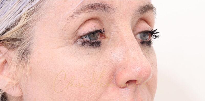 Rhinoplasty Before & After Photo