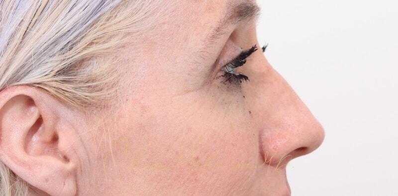 Rhinoplasty Before & After Photo