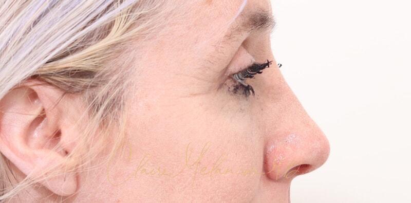 Rhinoplasty Before & After Photo