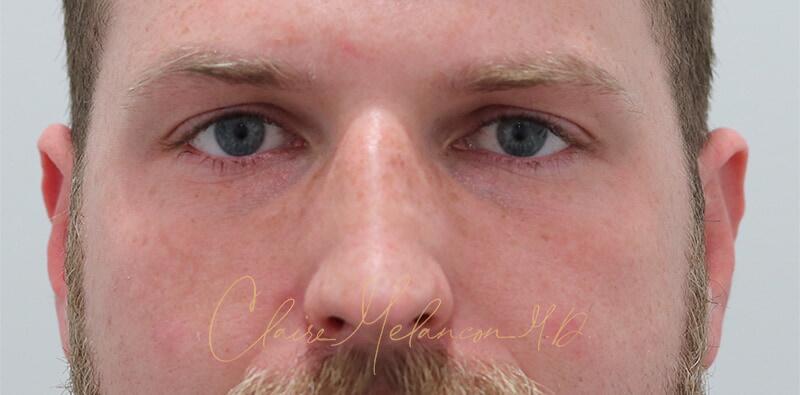Rhinoplasty Before & After Photo