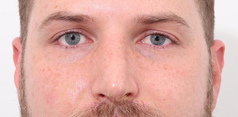 Rhinoplasty Before & After Photo