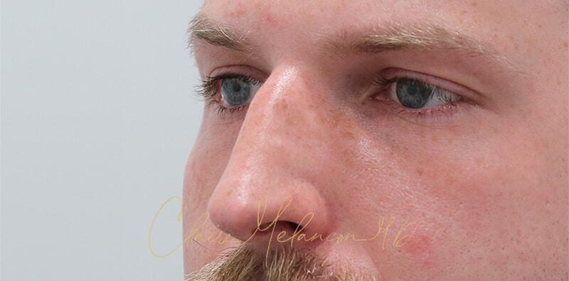 Rhinoplasty Before & After Photo