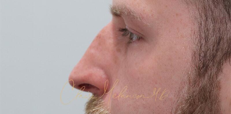 Rhinoplasty Before & After Photo