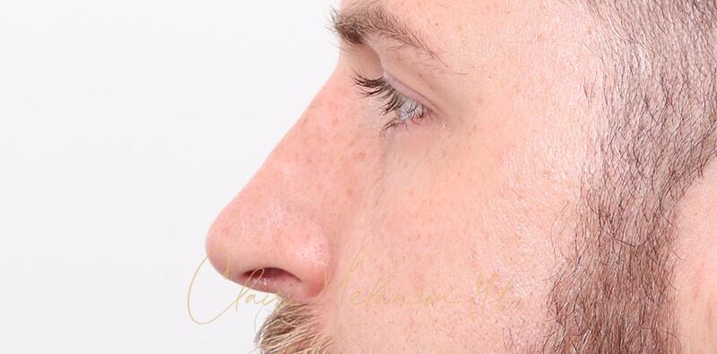 Rhinoplasty Before & After Photo