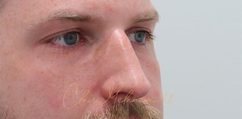 Rhinoplasty Before & After Photo
