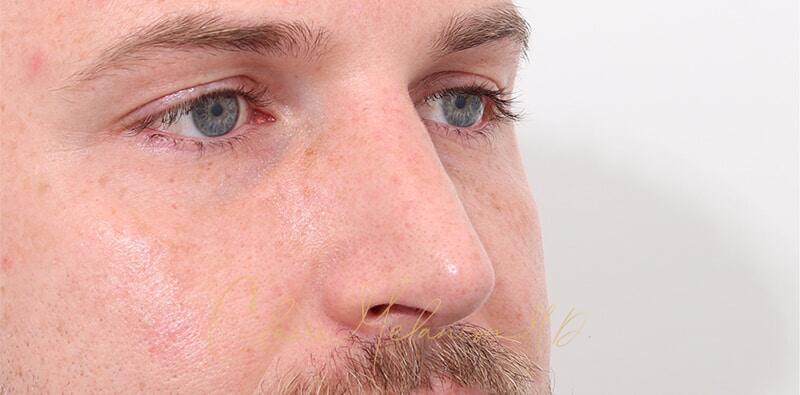 Rhinoplasty Before & After Photo