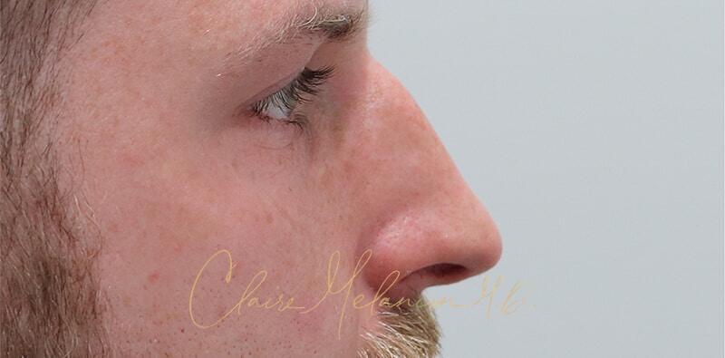 Rhinoplasty Before & After Photo