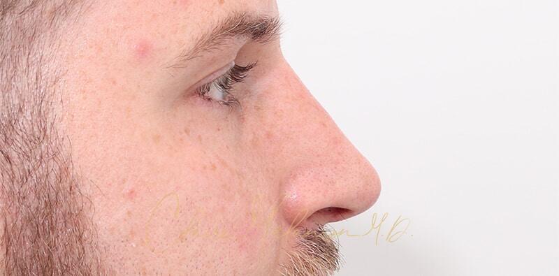 Rhinoplasty Before & After Photo