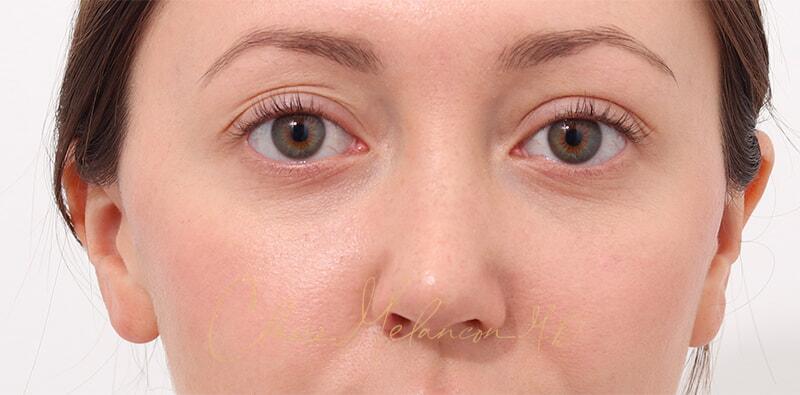 Rhinoplasty Before & After Photo