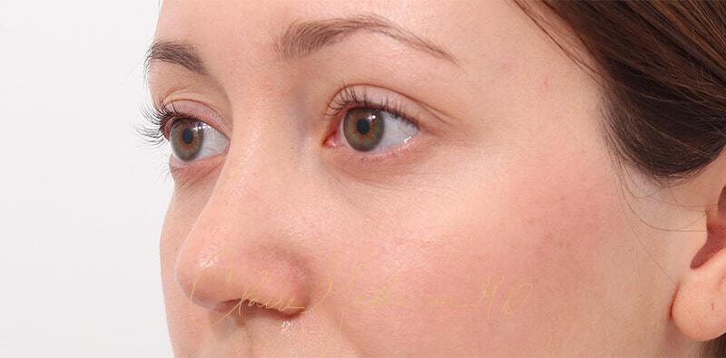 Rhinoplasty Before & After Photo