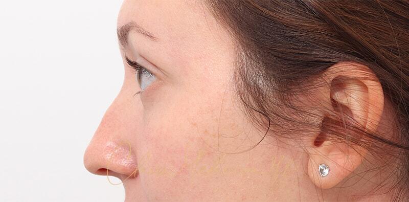 Rhinoplasty Before & After Photo