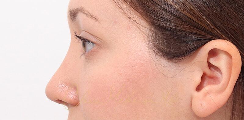 Rhinoplasty Before & After Photo
