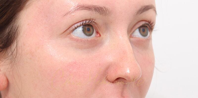 Rhinoplasty Before & After Photo