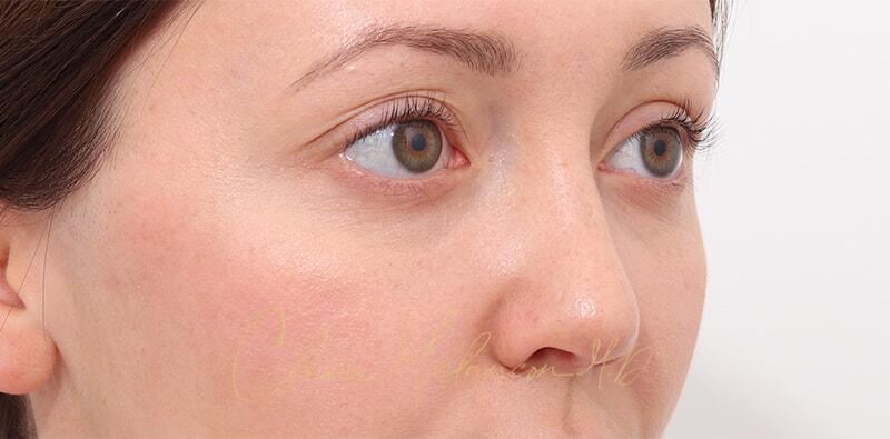 Rhinoplasty Before & After Photo