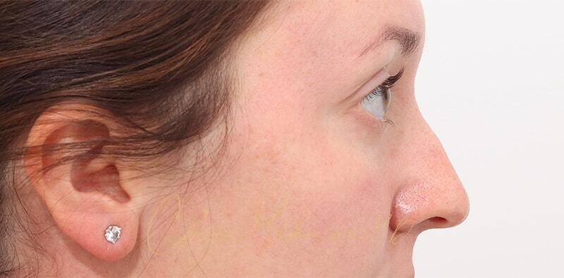 Rhinoplasty Before & After Photo