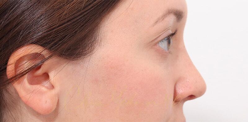 Rhinoplasty Before & After Photo