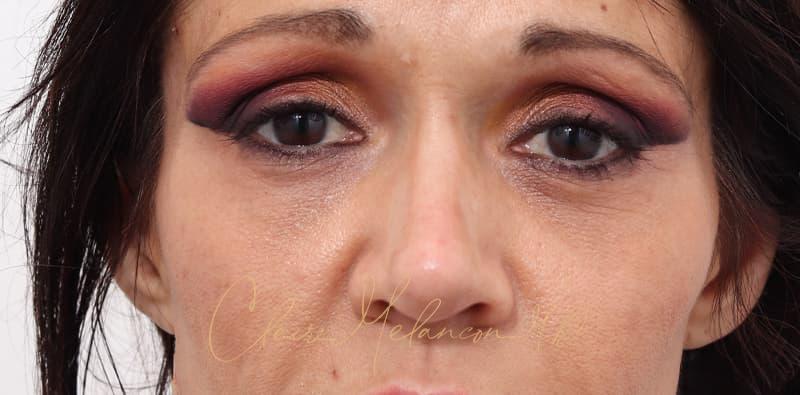 Rhinoplasty Before & After Photo