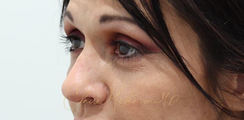 Rhinoplasty Before & After Photo