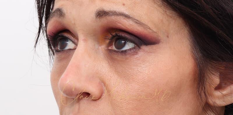 Rhinoplasty Before & After Photo