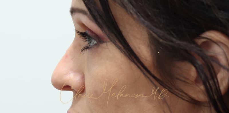 Rhinoplasty Before & After Photo