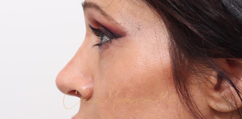 Rhinoplasty Before & After Photo