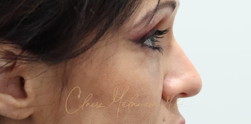 Rhinoplasty Before & After Photo