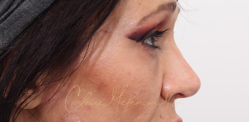 Rhinoplasty Before & After Photo