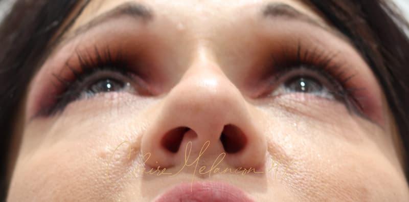 Rhinoplasty Before & After Photo