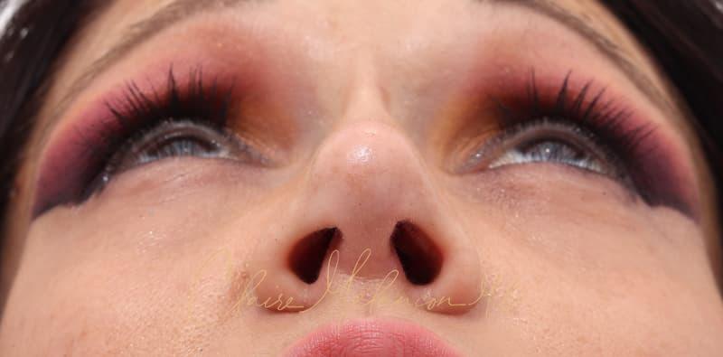 Rhinoplasty Before & After Photo