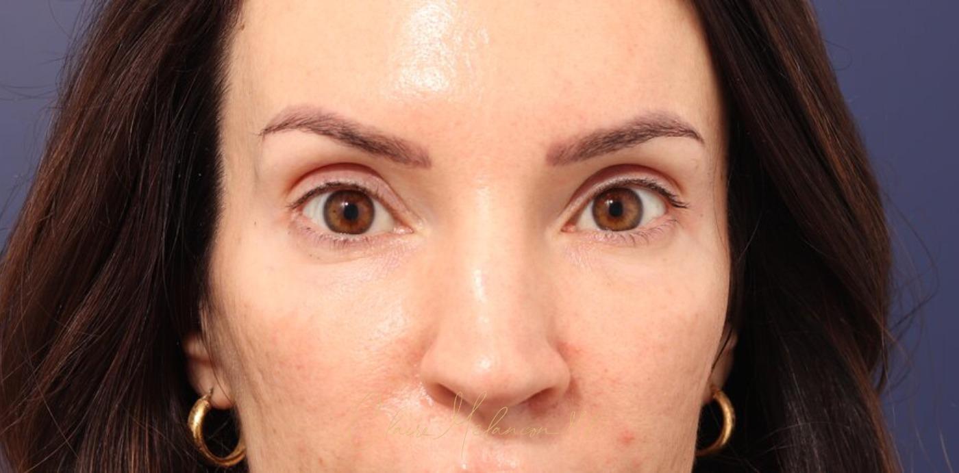 Rhinoplasty Before & After Photo