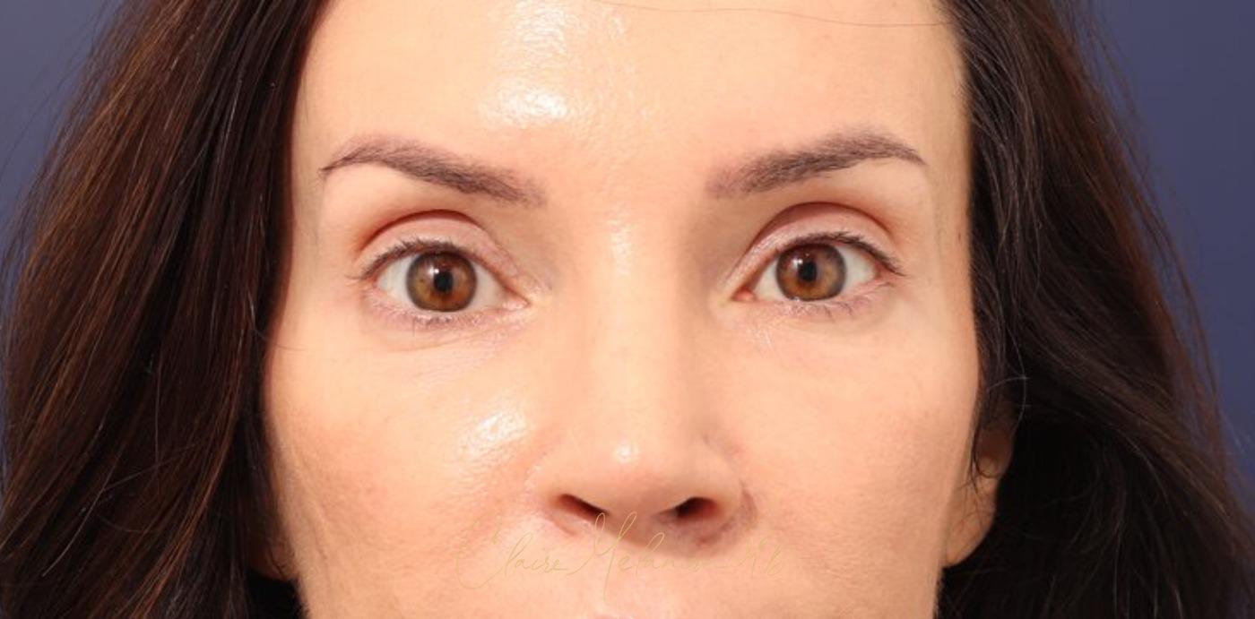 Rhinoplasty Before & After Photo