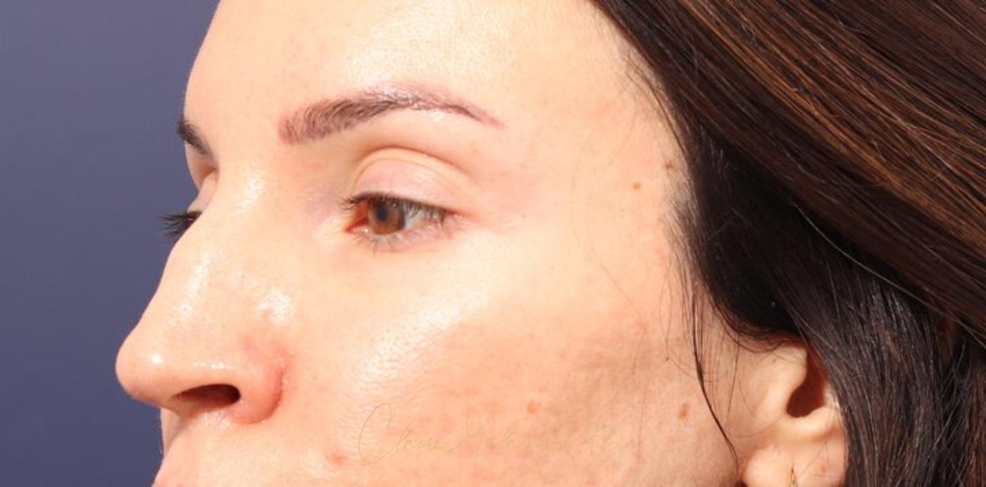 Rhinoplasty Before & After Photo