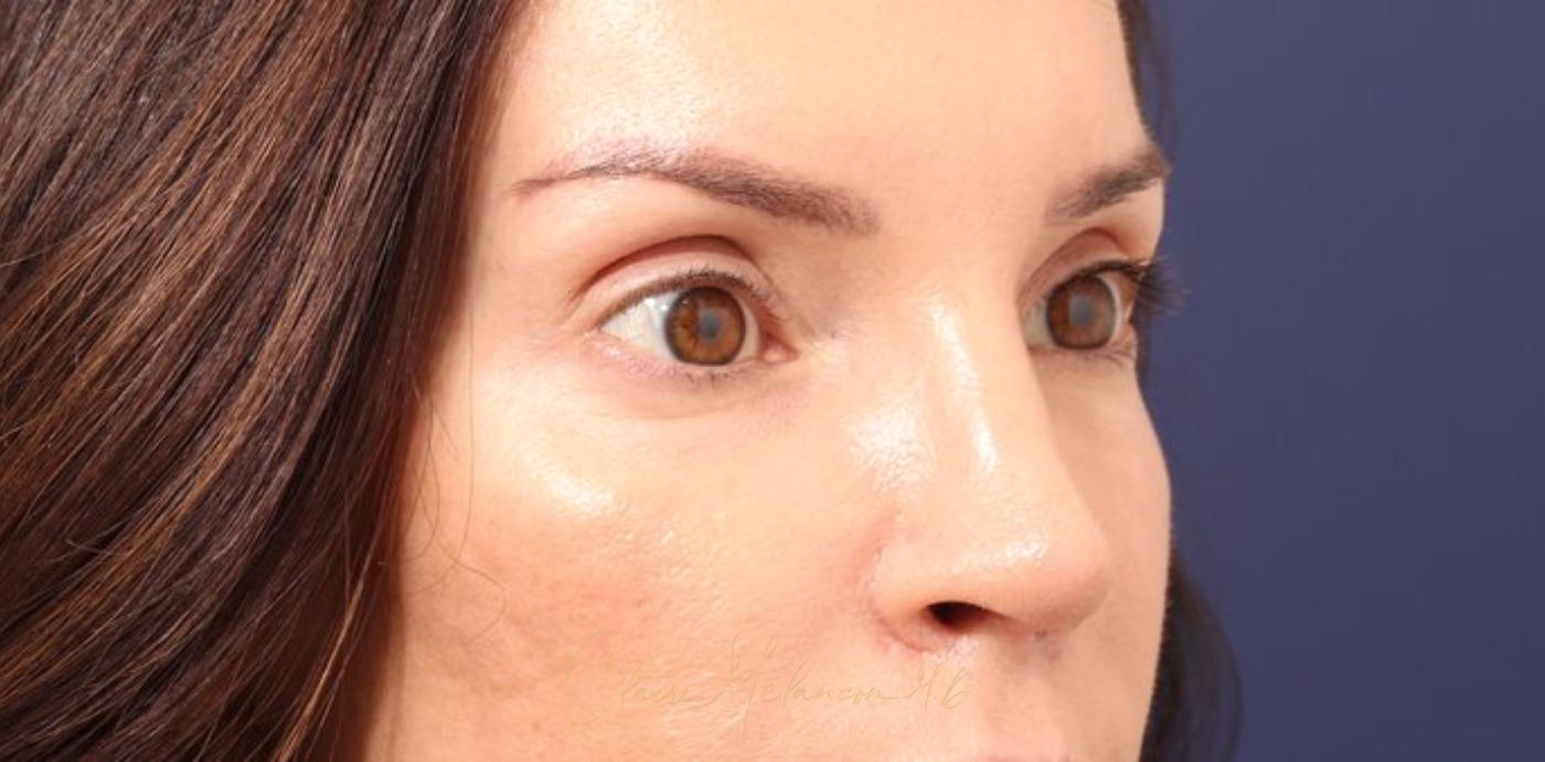 Rhinoplasty Before & After Photo