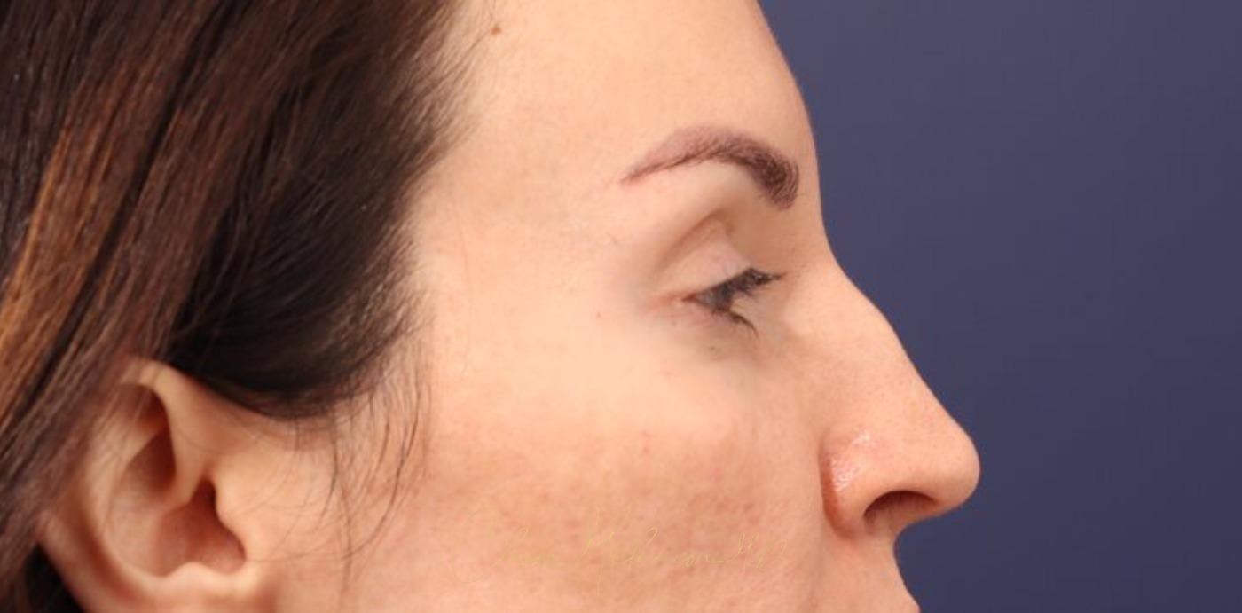 Rhinoplasty Before & After Photo