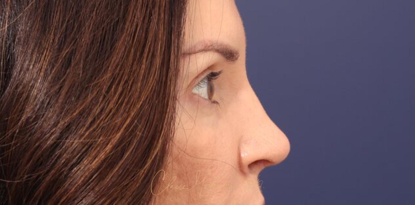 Rhinoplasty Before & After Photo