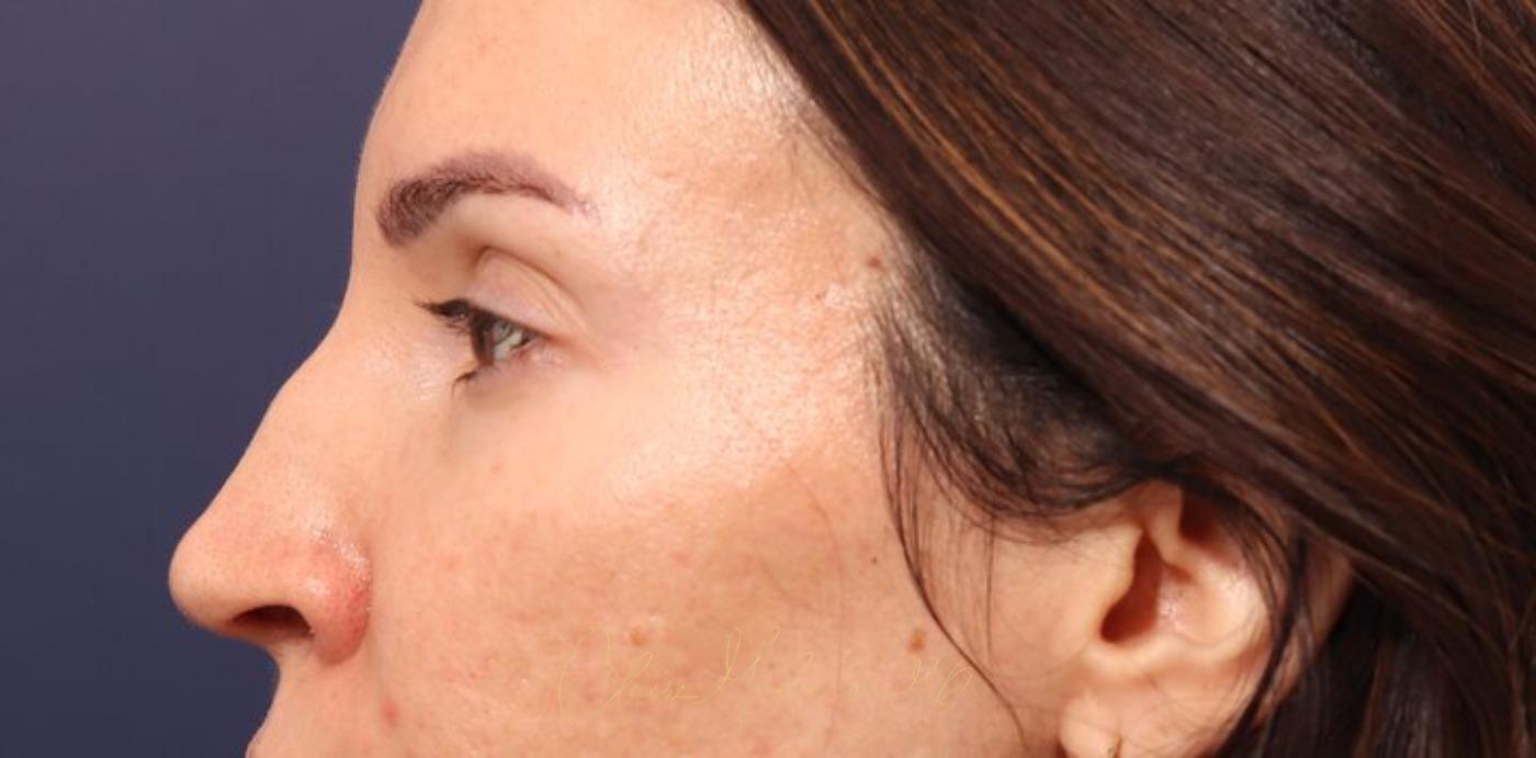 Rhinoplasty Before & After Photo