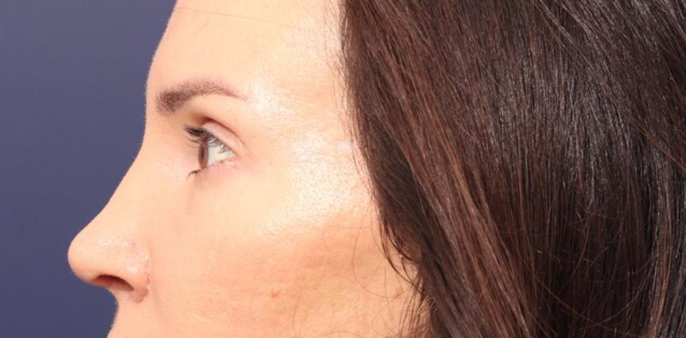 Rhinoplasty Before & After Photo