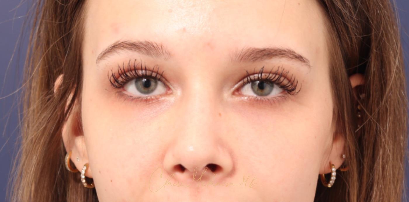 Rhinoplasty Before & After Photo