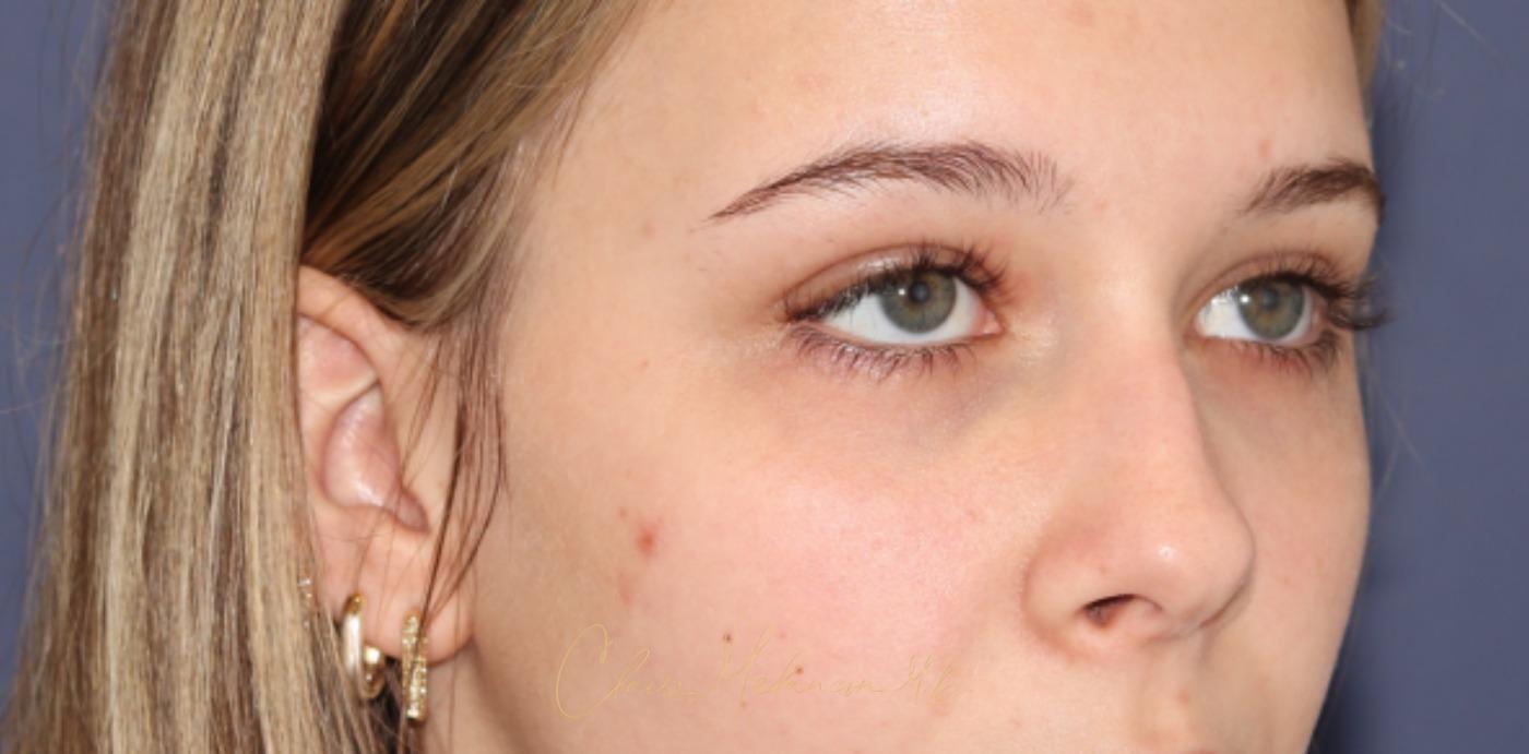 Rhinoplasty Before & After Photo