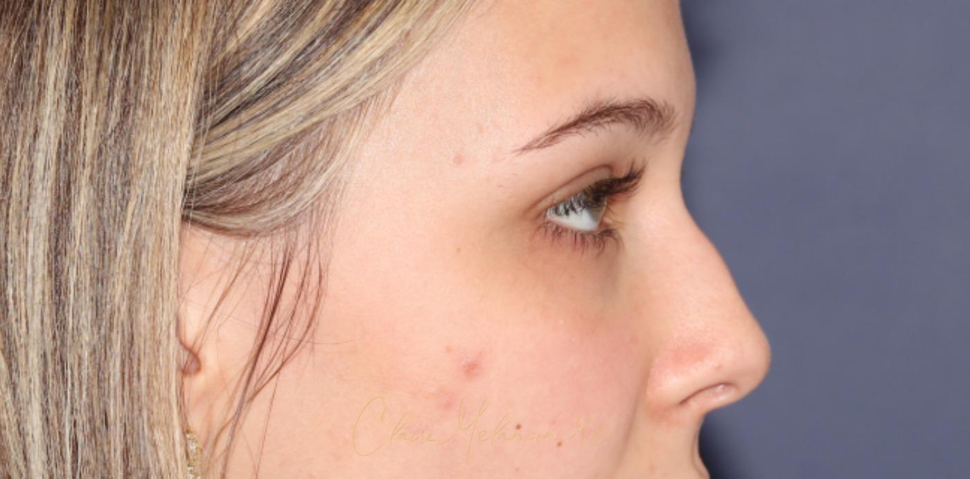 Rhinoplasty Before & After Photo