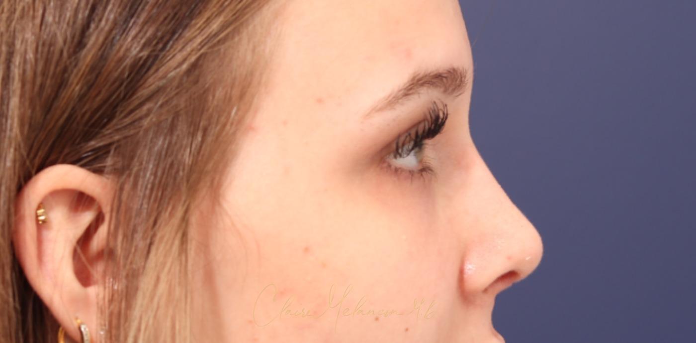 Rhinoplasty Before & After Photo