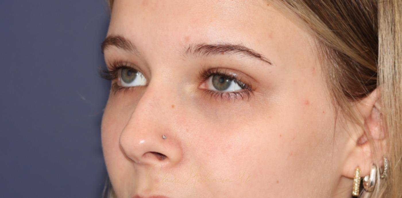 Rhinoplasty Before & After Photo